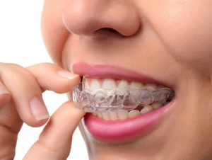 Girl placing clear aligners