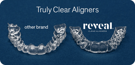 Reveal Clear Aligners Comparison
